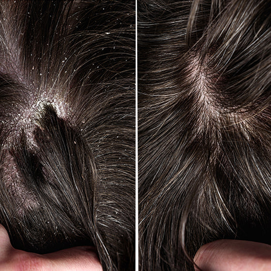 Dry-Scalp-Shampoo-for-Men