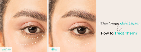 What Causes Dark Circles Under Your Eyes and How to Treat Them?